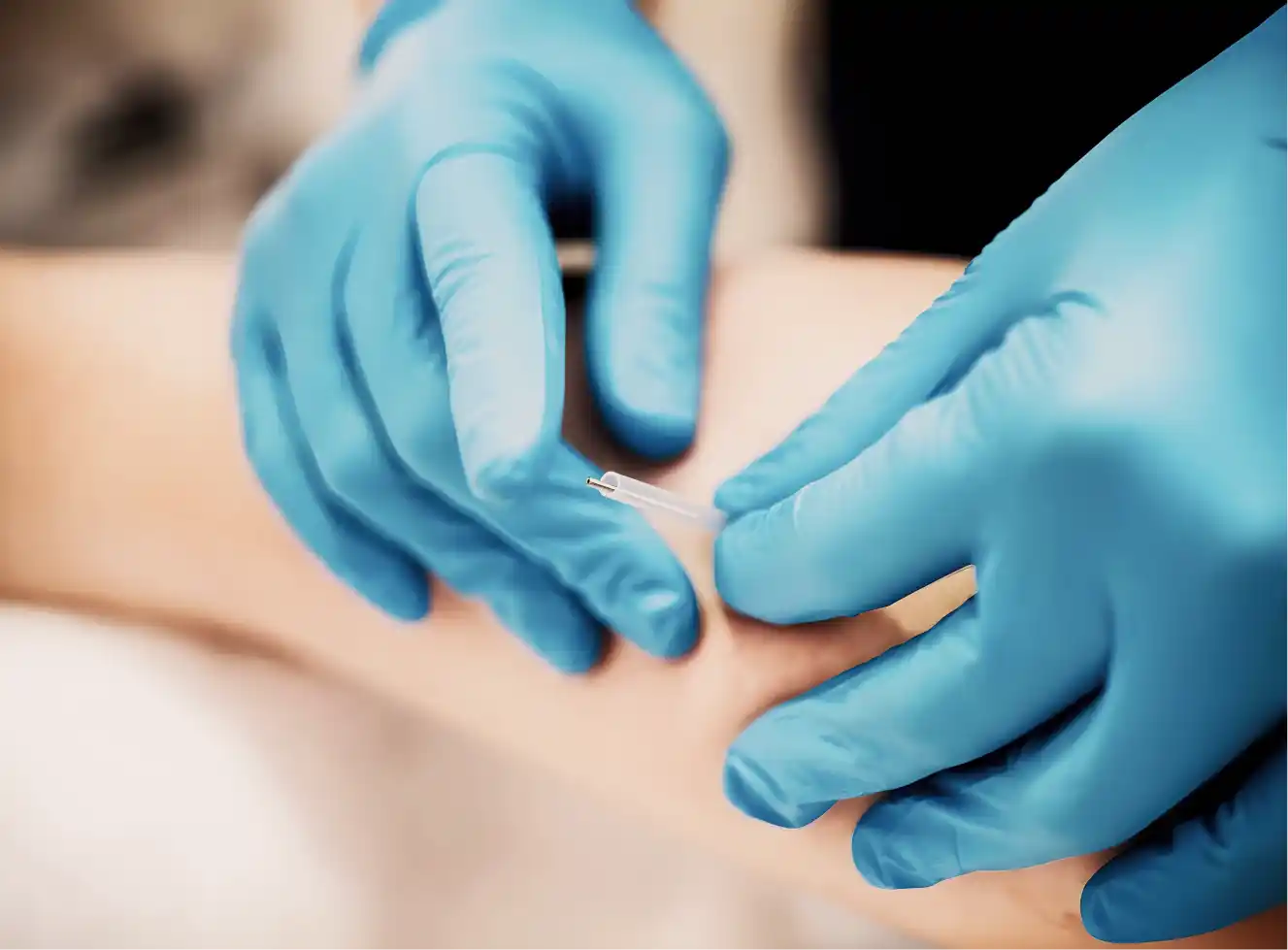 Dry Needling